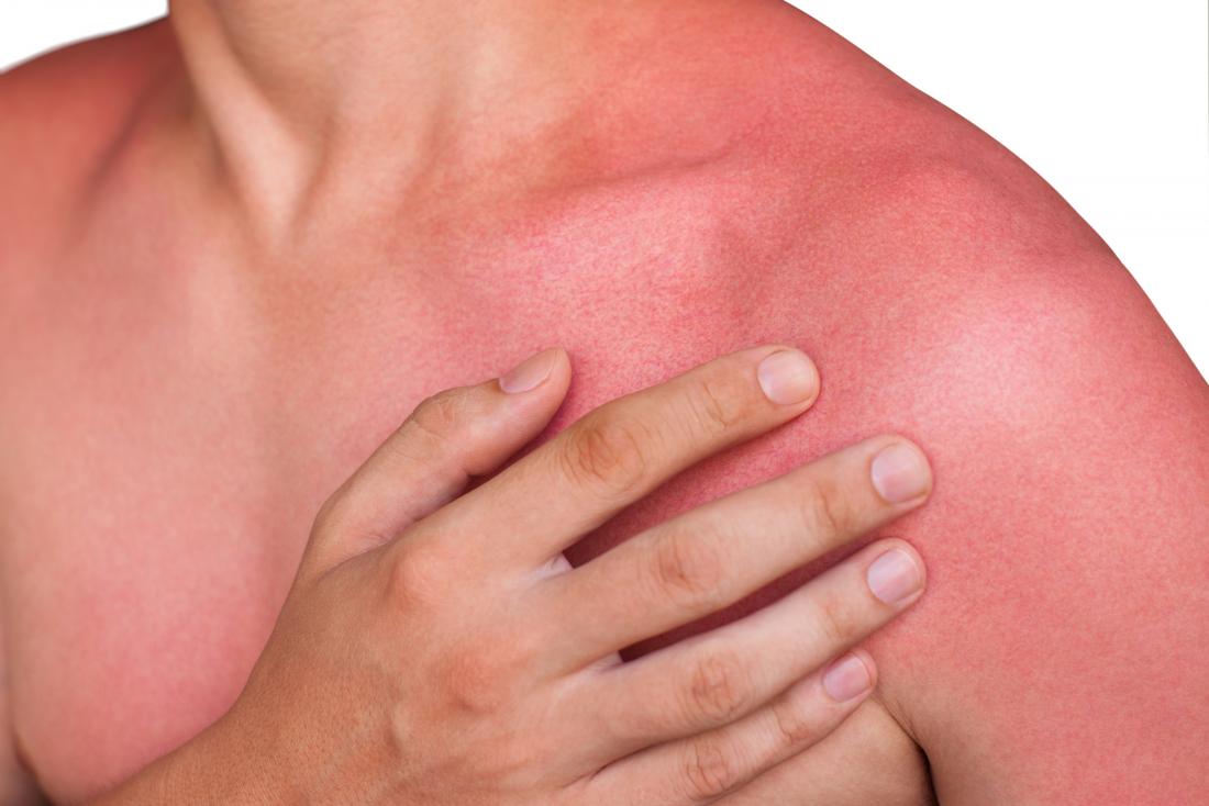 skin redness sunburn