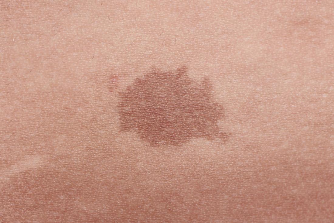 brown mark on skin