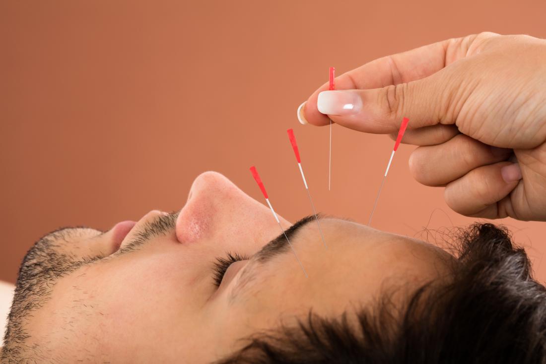 Man having acupuncture on his forehead