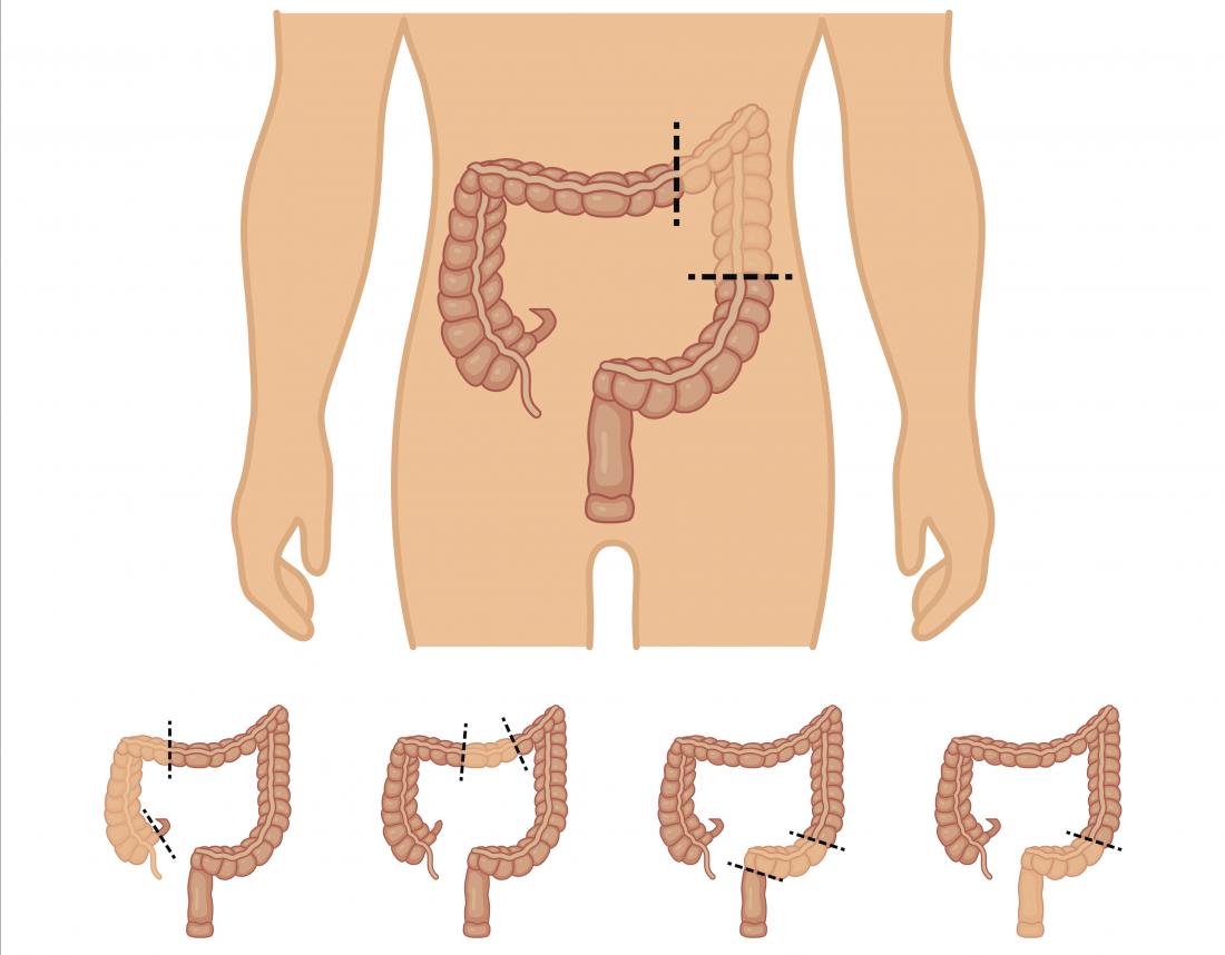 types of colectomy