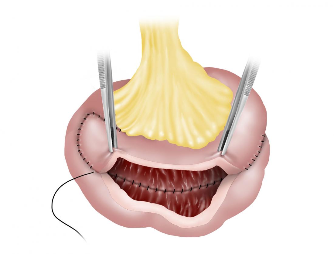 diagram of strictureplasty surgery