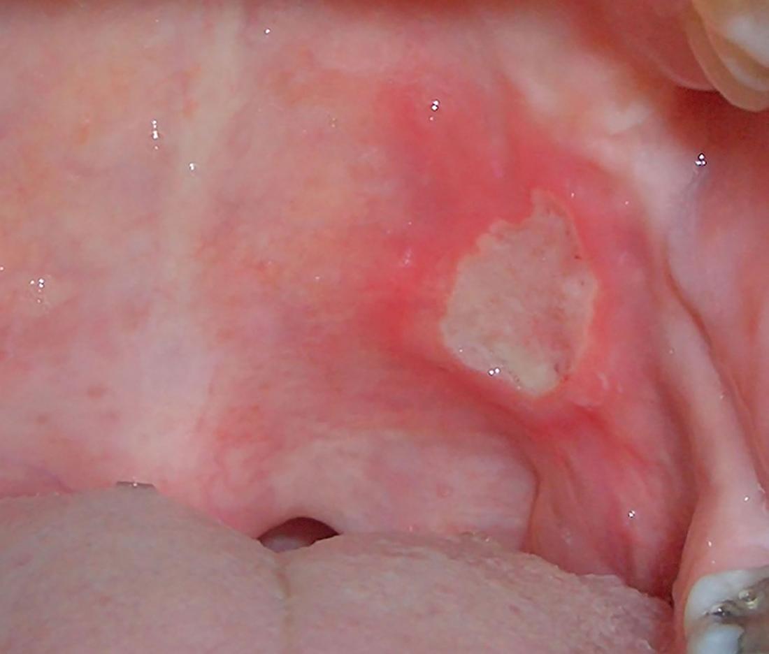 Aphthous ulcer in the back of the mouth. Image Credit: Ryanfransen, 2007