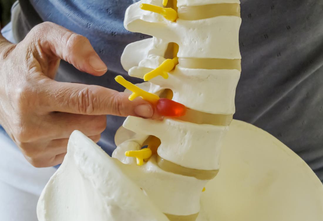 Model of spinal column showing discs and vertebra.