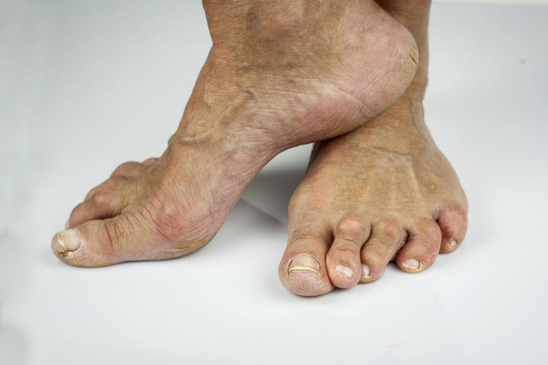 Rheumatoid arthritis in the feet