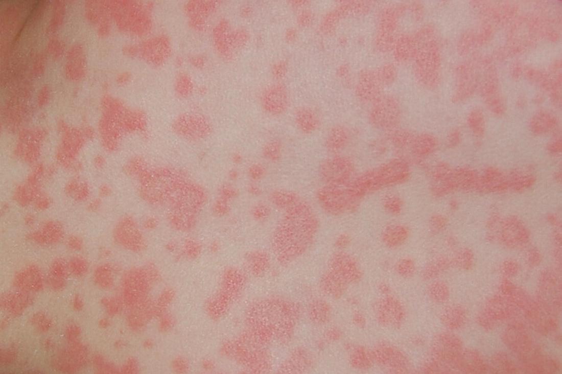 amoxicillin rash. Image credit: Skoch3, (2008, February 17)