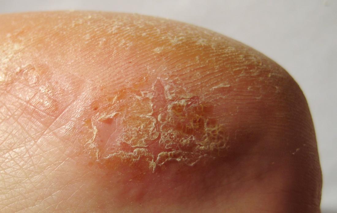 Contact dermatitis. Image credit: <!--mce:protected %0A-->Floreana, 2010.