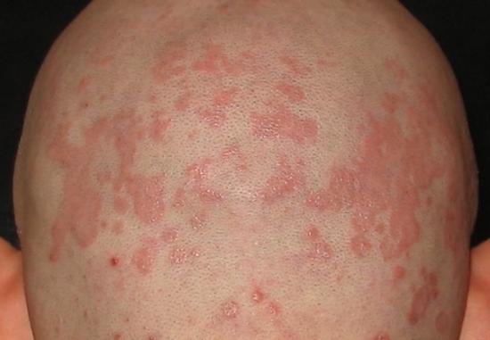 Seborrheic dermatitis. Image credit: Amras666, 2008.