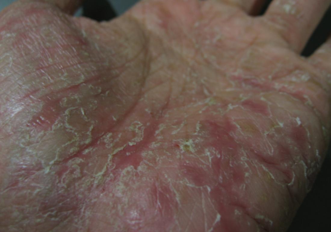 Dyshidrotic eczema. Image credit: Eugene Alvin Villar, 2008.