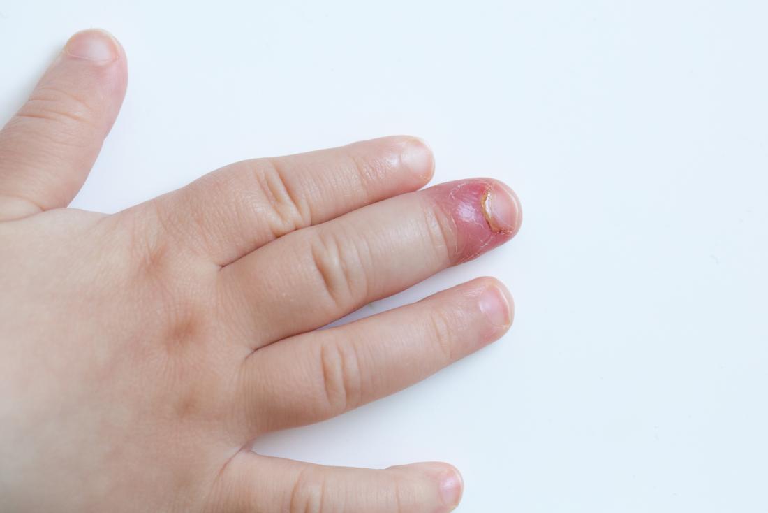 Fingernail bed inflammation, bacterial infection paronychia in child's hand.