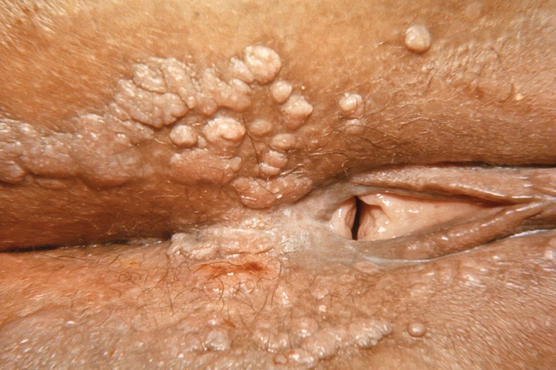 Syphilis on vagina. Image credit: CDC, 1969.
