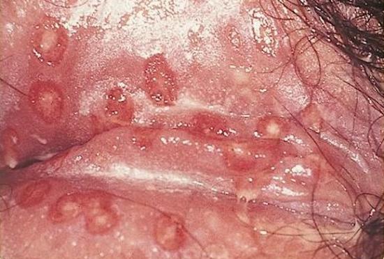 Genital herpes on vagina. Image credit: GerardM, 2005.
