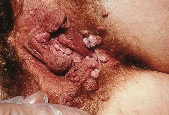 Genital warts on vagina. Image credit: SOA-AIDS Amsterdam, 2005.