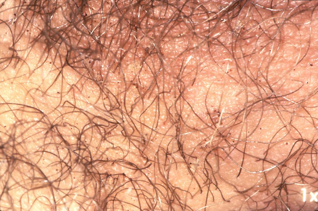 Pubic lice. Image credit: CDC/ Reed and Carnrick Pharmaceuticals, 1976.