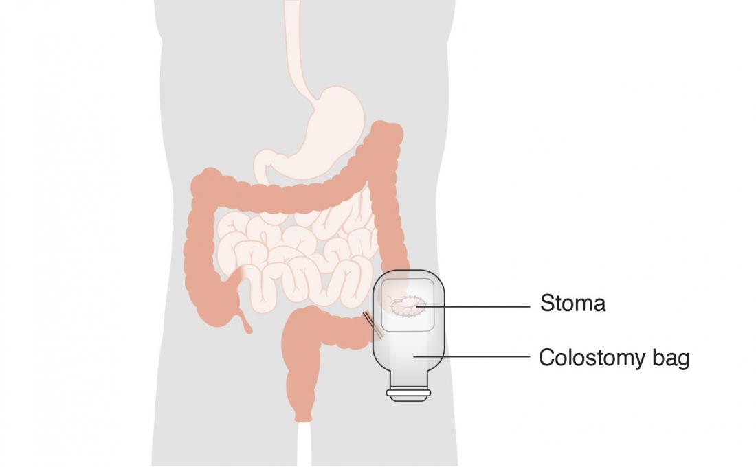 Surgery diagram for stoma and colostomy bag.