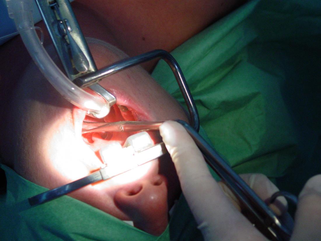 tonsillectomy procedure <br>Image credit: Welleschik, 2001</br>