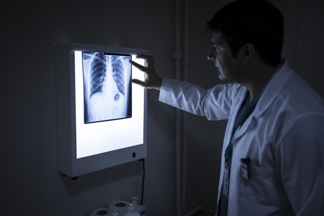 lung x-ray drug damage