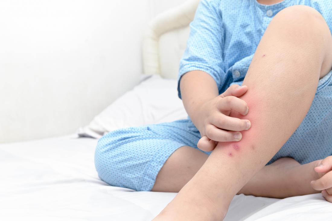 Child scratching itchy rash on leg.