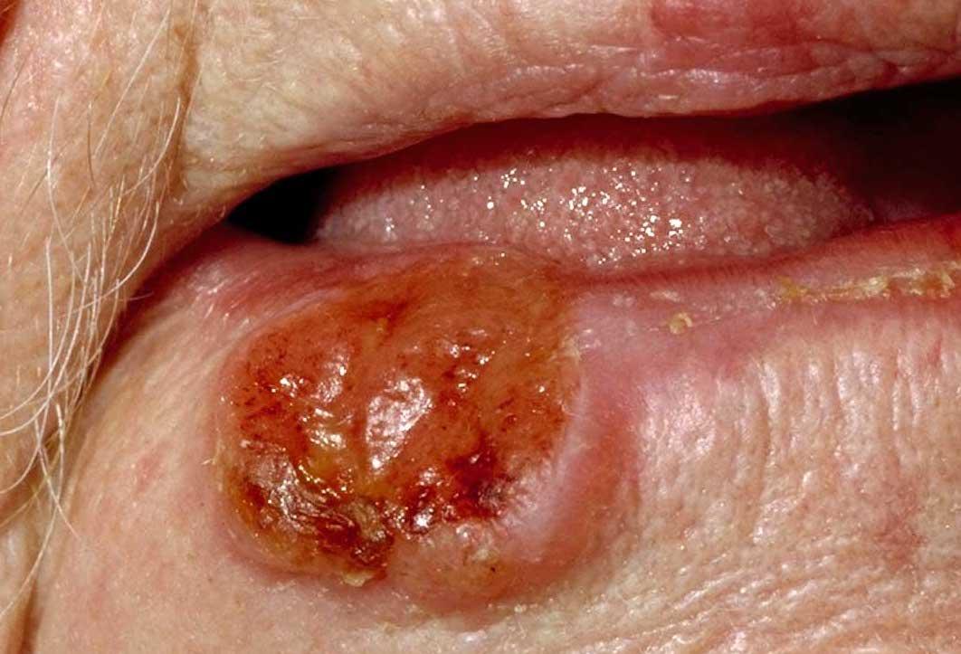 oral or mouth cancer on lip