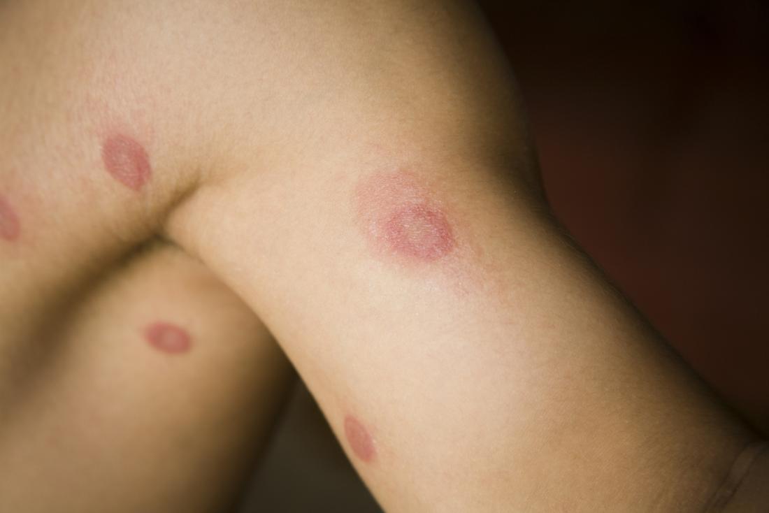discolored skin patches ringworm