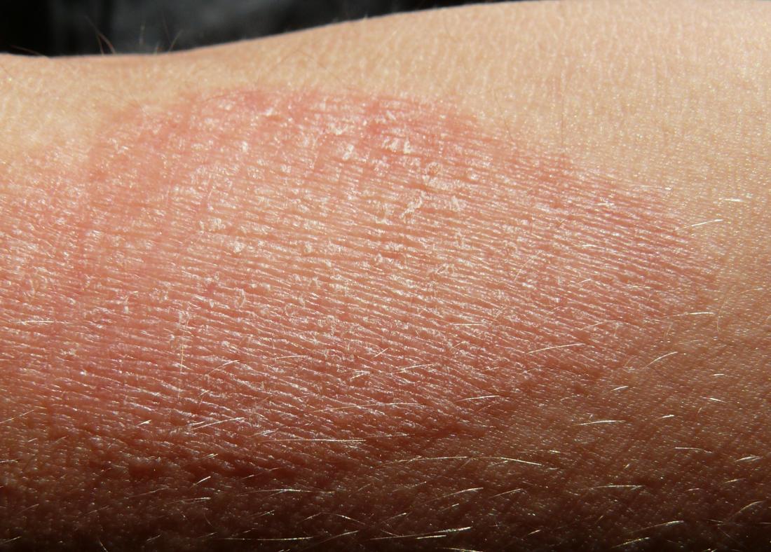 Atopic dermatitis. Image credit: G.steph.rocket, 2015.