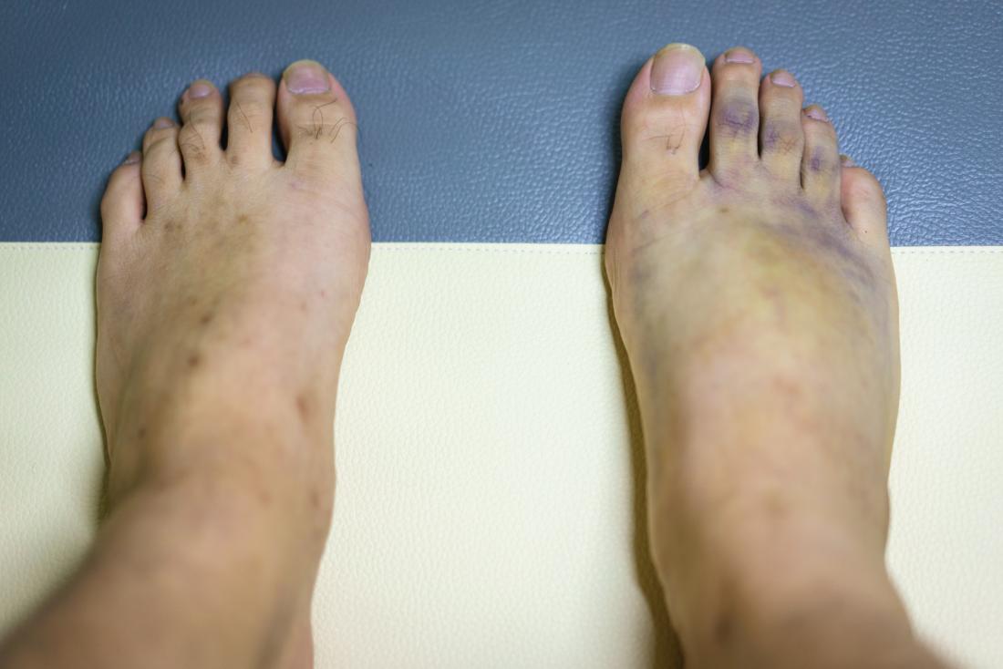 Purple bruised feet with swollen areas