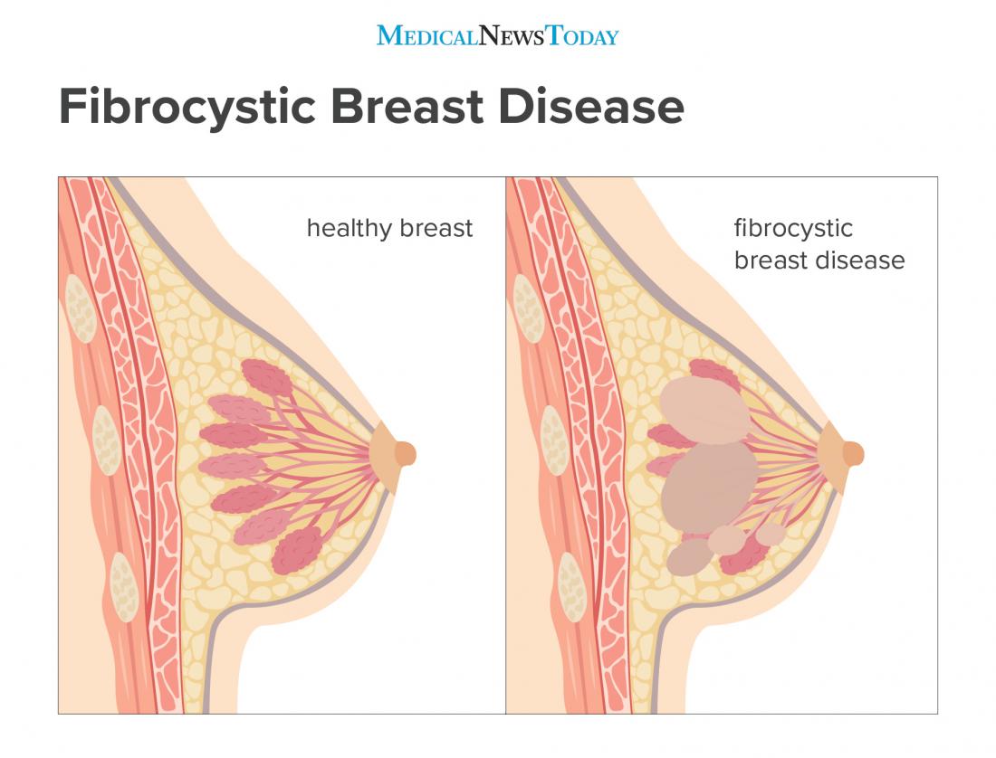 fibrocystic breast disease infographic <br>Image credit: Stephen Kelly, 2018</br>