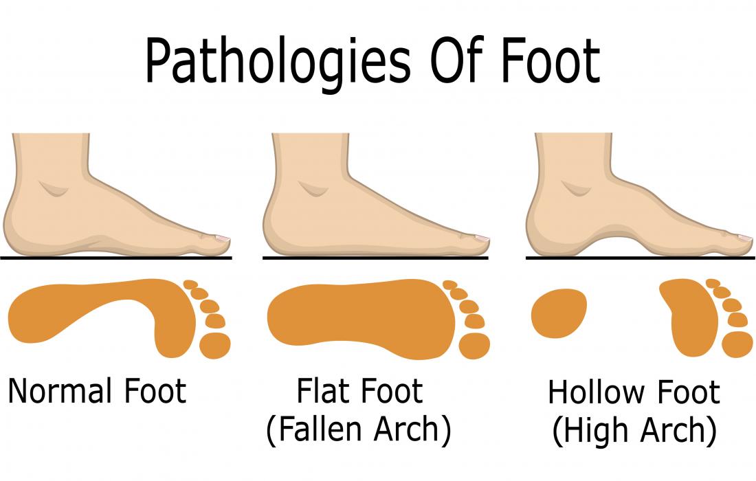 Overpronation, causing fallen arch and flat foot, demonstrated in diagram alongside hollow foot or high arch, known as supination.