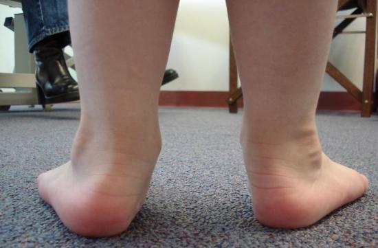 Overpronation and flat feet or fallen arches. Image credit: FA RenLis, (2011, January 26)