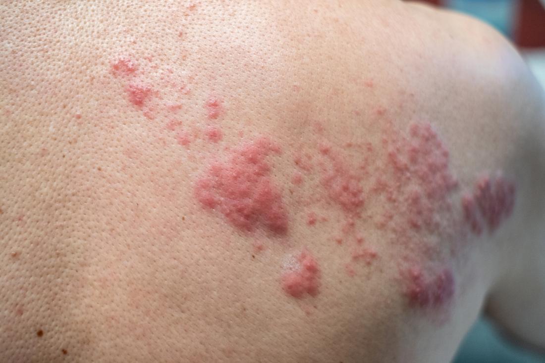 Shingles rash on person's shoulder