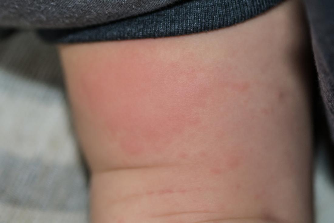 hives allergic reaction in baby