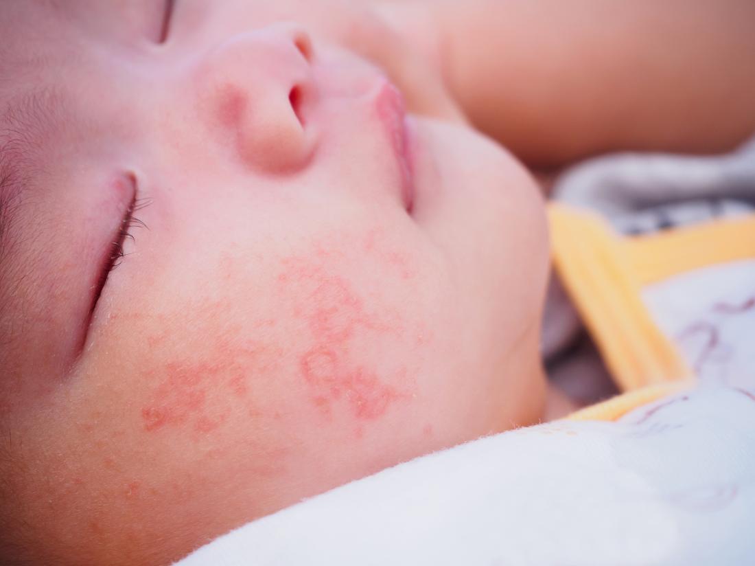 eczema allergic reaction in baby