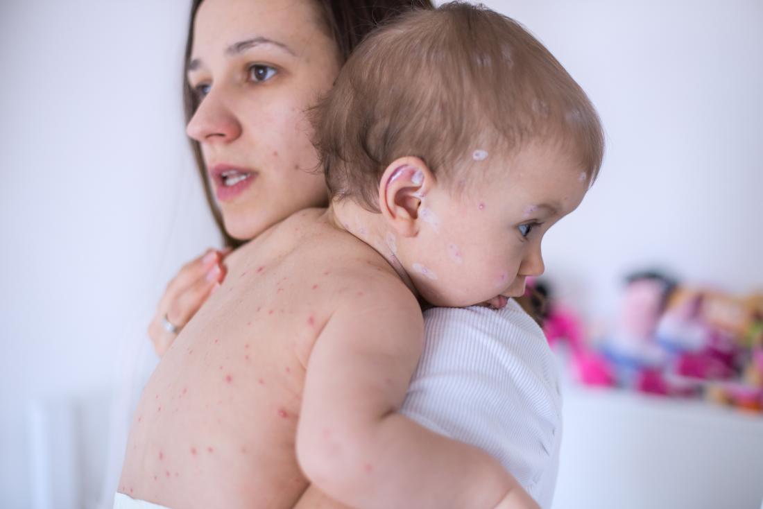 Baby with chickenpox causing spots all over their body being held by mother.