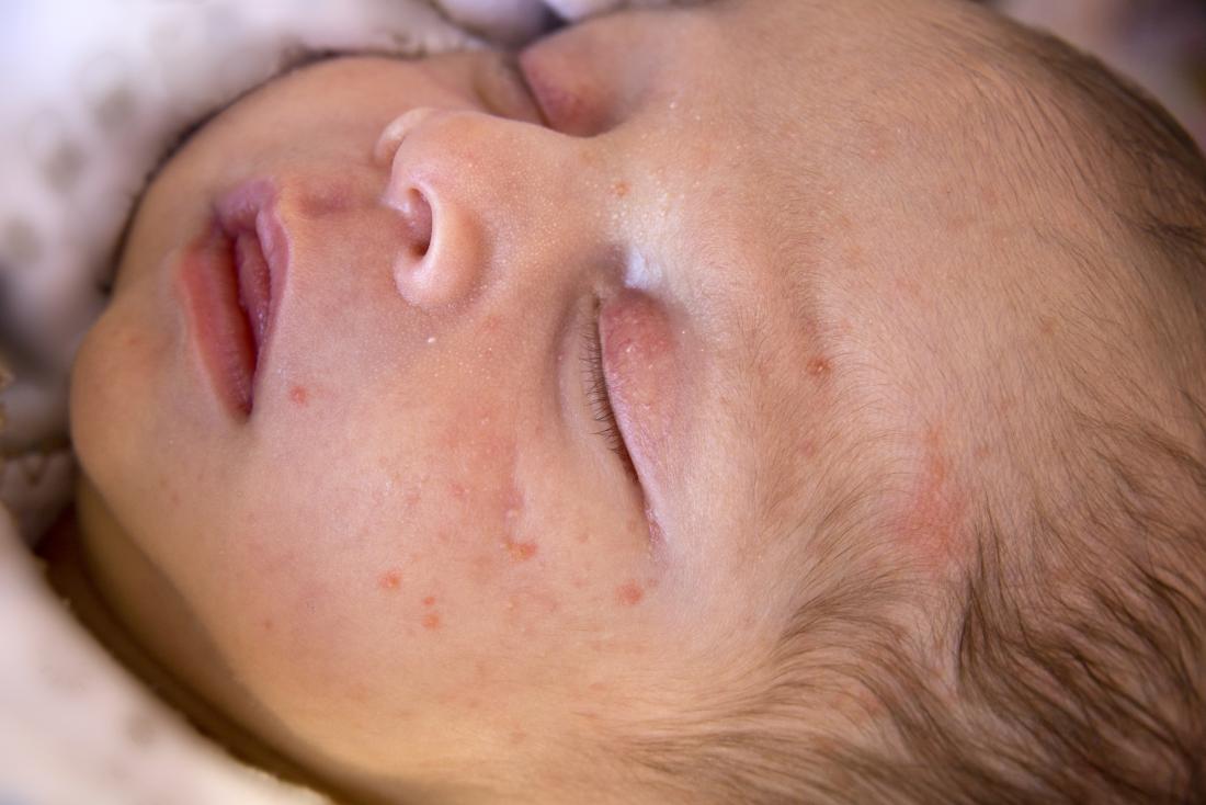 Baby with acne and spots on face.