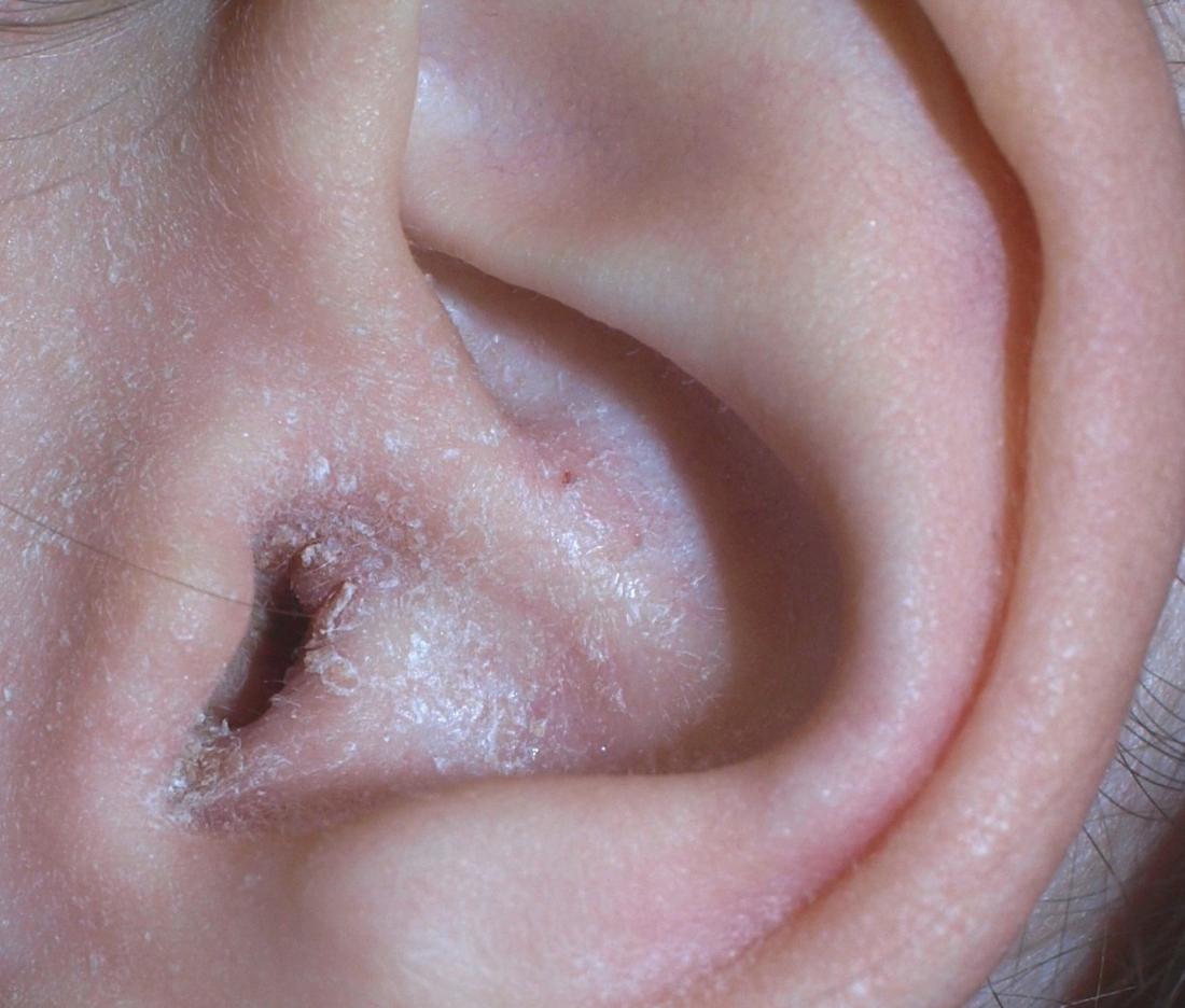 Ear eczema <br>Image credit: Klaus D. Peter, 2008</br>