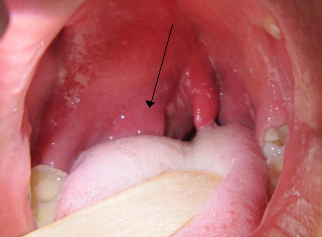 peritonsillar abscess. Image credit: James Heilman, MD, 2011