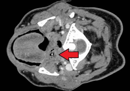 peritonsillar abscess brain scan. Image credit: James Heilman,MD, 2016.