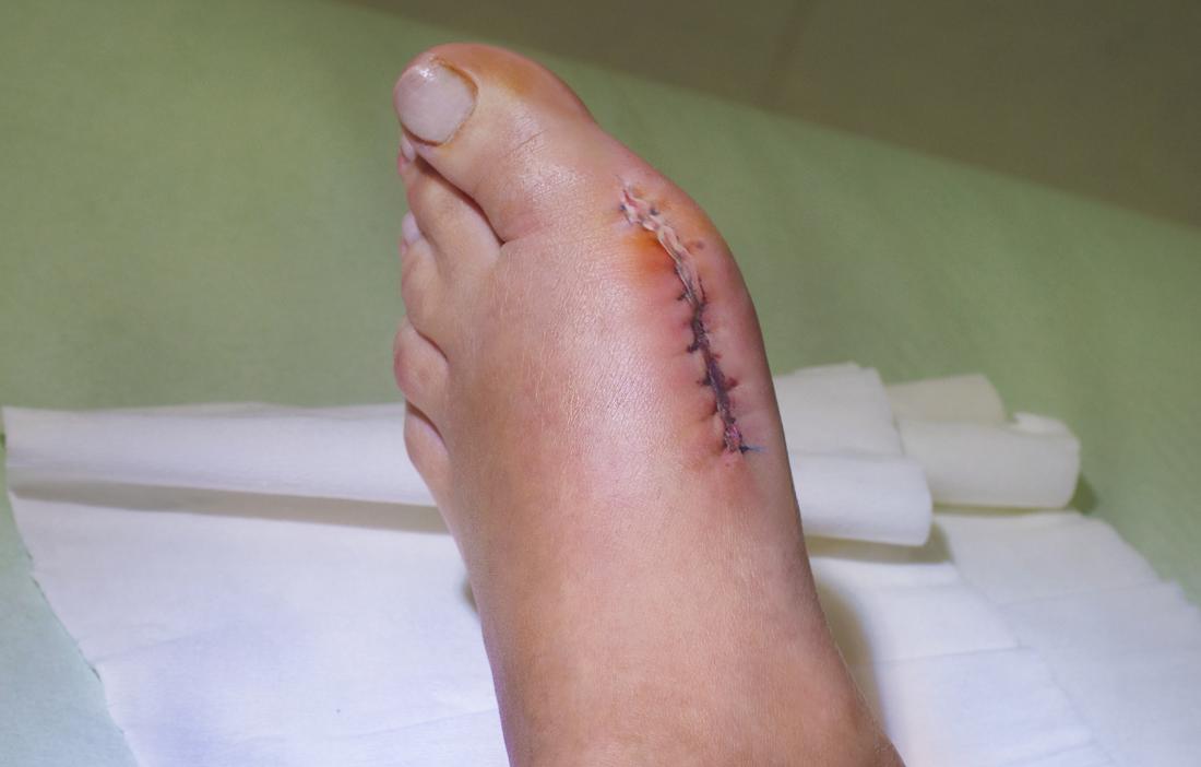 persons foot with stitches after bunion removal surgery