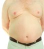 Are enlarged breasts in men a medical condition (gynecomastia) or from excess body fat (pseudogynecomastia)?