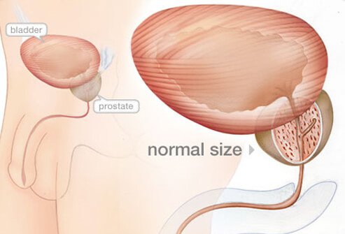 Enlarged Prostate (BPH) Symptoms, Diagnosis, Treatment