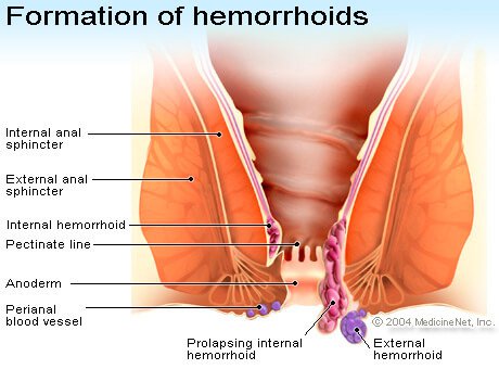 Picture of Hemorrhoids