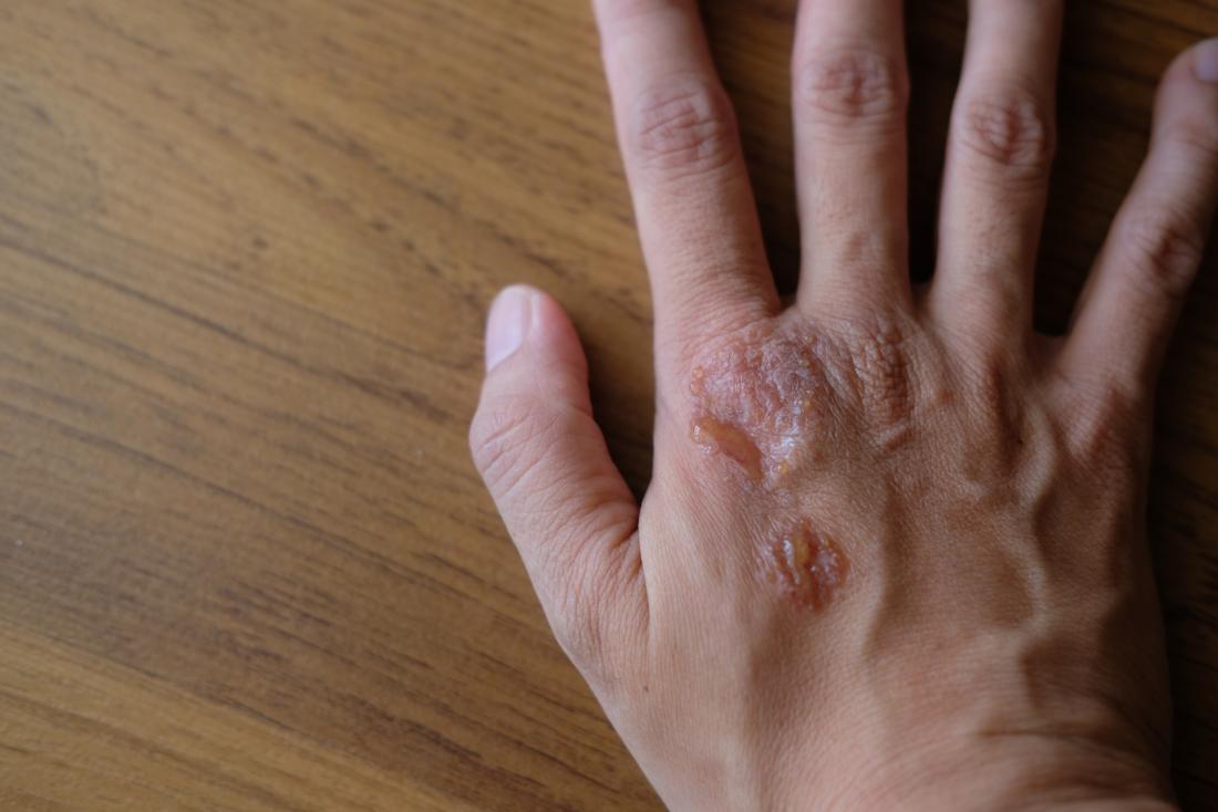 Psoriasis on the hand