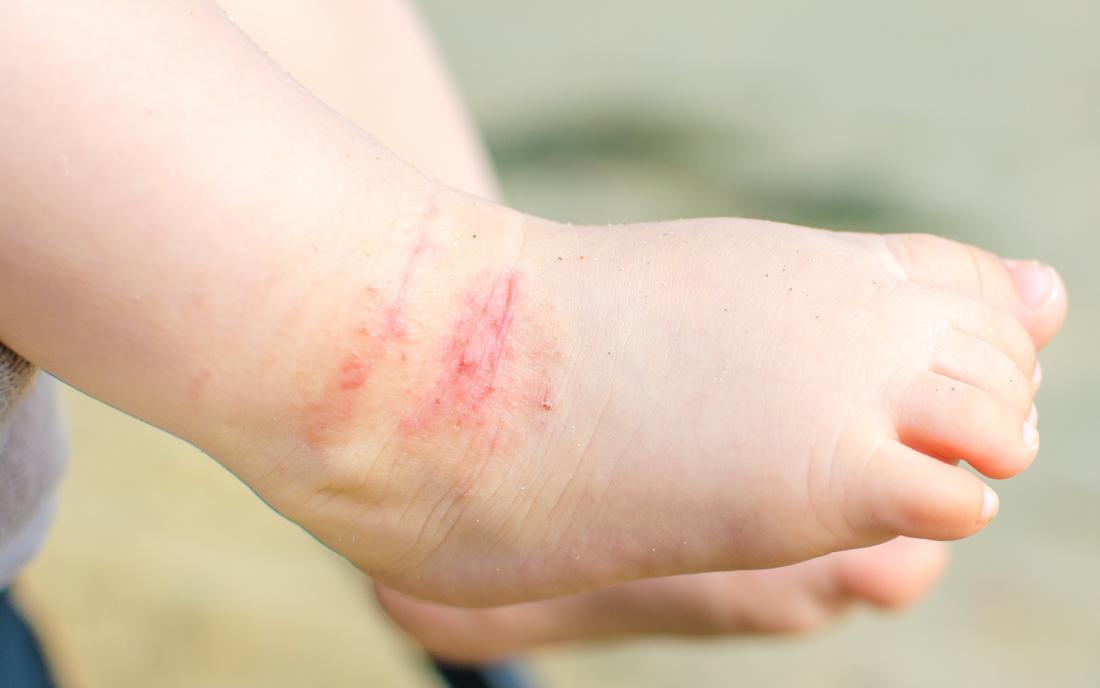 Baby with atopic dermatitis or eczema rash on foot