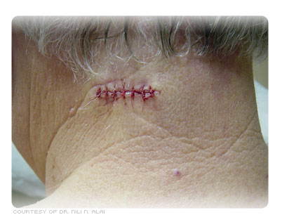 Post-op closure of the wound with sutures