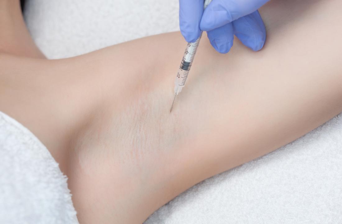 Botox injection in underarm to treat excessive sweating or hyperhidrosis