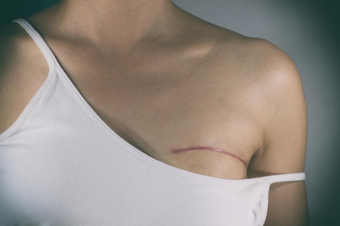 multifocal breast cancer scar