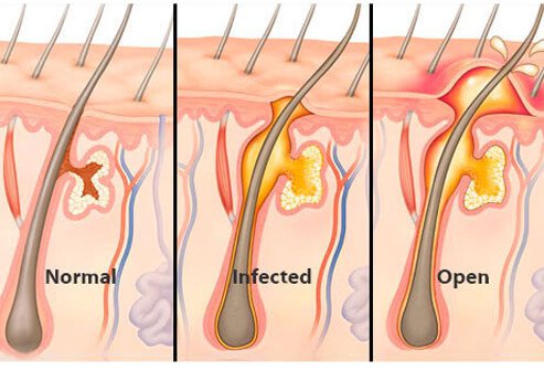 Boils: Pictures, Causes, Symptoms and Treatment