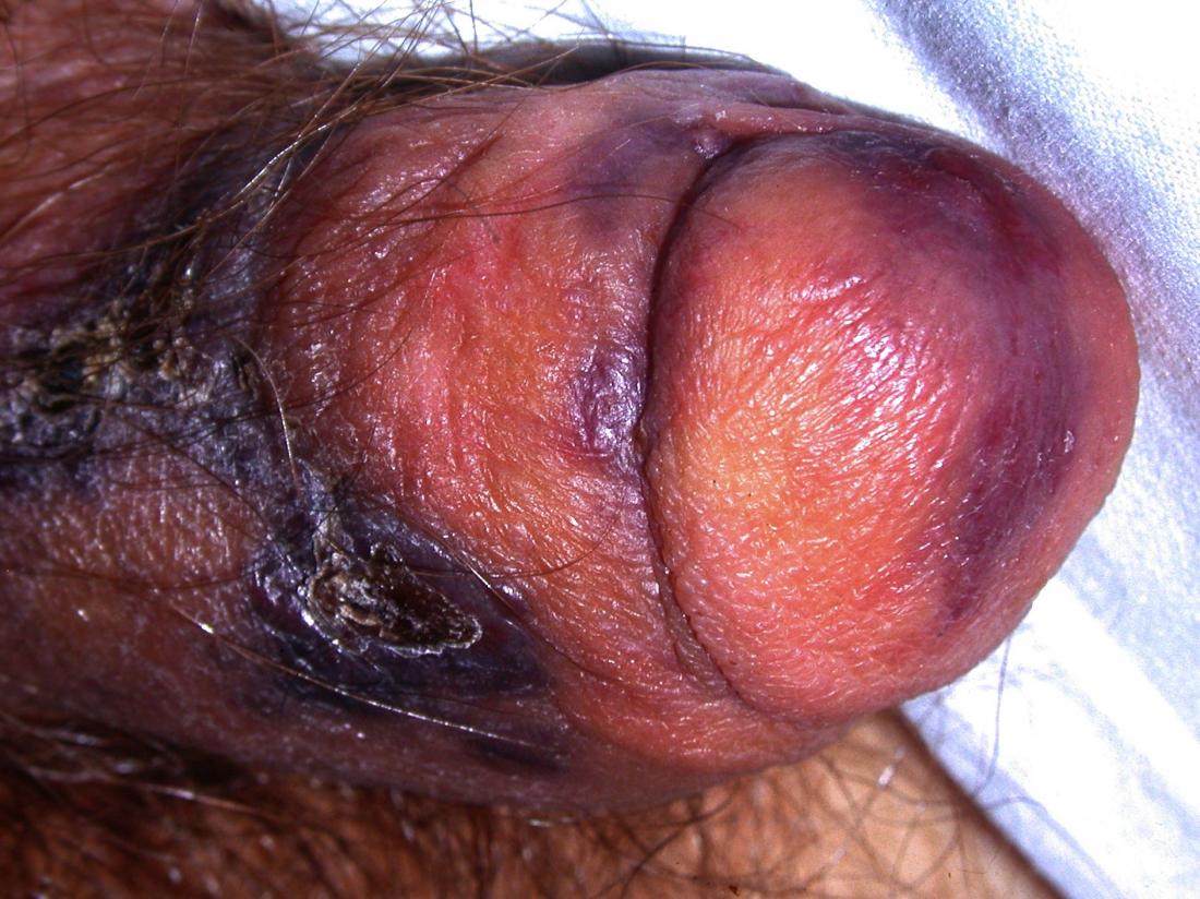 Penile primary melanoma