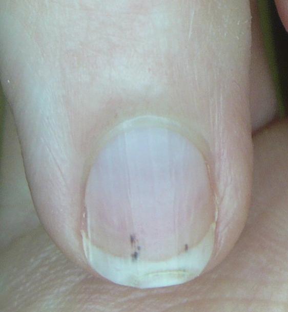 psoriatic arthritis nails splinter