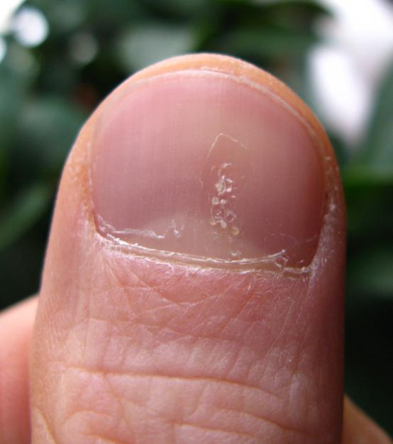 psoriatic arthritis nails pitting