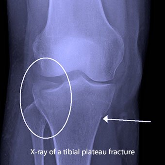 X-ray of a tibial plateau fracture.